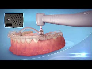 Dental implants: Bondbone surgery, oral treatments, implants (3d animation)