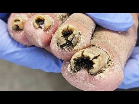 A hole is formed on the nail, and it is trimmed perfectly~【Dr. Liu's Pedicur】