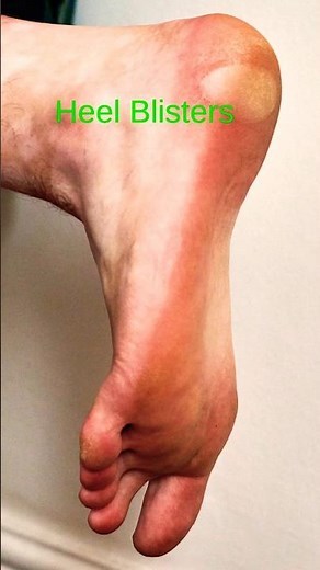 Heel Blisters? Stop Foot Pain Fast! 👟✨