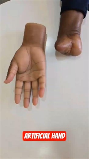 Wrist Amputee Gets Advanced Silicone Prosthetic Hand Bionic Hand Transformation Life Changing Moment