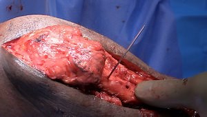 Tibial Tubercle Osteotomy and Proximalization for Chronic Patella Baja