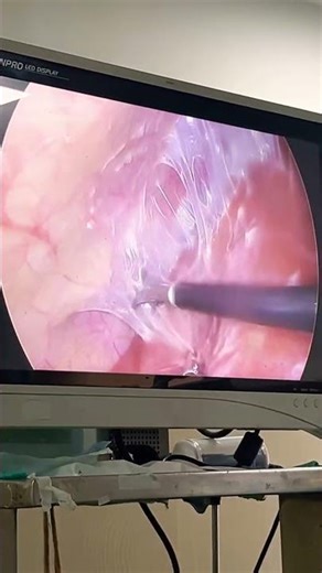 Fitz Hugh Curtis Syndrome-complication of advanced PID-causing peri hepatitis and RUQ Pain. #doctor