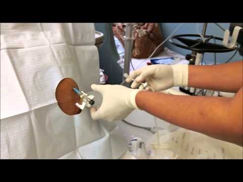 Boards To Wards - How To Measure Pleural Manometry