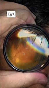 smartphone fundoscopy #smartphone #fundoscopy