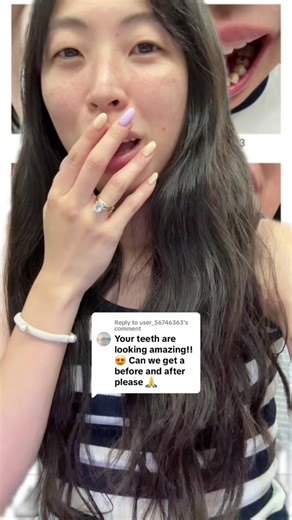 Invisalign Transformation: Before & After (1 Year 3 Months Progress)