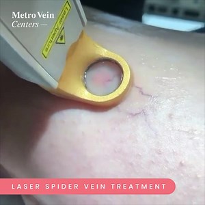 2.2K views · 46 reactions | Introducing the ExcelV+ Laser, the latest advancement in non-invasive spider vein treatment. The ExcelV+ laser is now offered at most Metro Vein Centers. Call today to schedule your free evaluation. | Metro Vein Centers | Facebook
