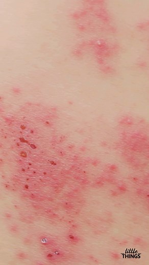 18K views · 11 reactions | MRSA is a superbug that causes swelling and irritation of the skin. It's a bacteria that resists most of the antibiotics out there. Here's what you need to know. #health #healthtip Read more>> bit.ly/3uM4env | Purple Clover | Facebook