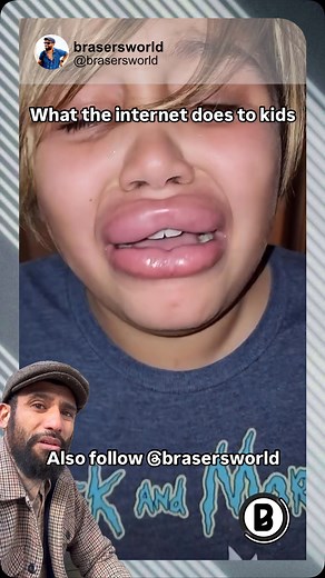 👄 Put the Vacuum Cleaner on Your Lips for 5 Minutes ☠️ ➡️ Follow @brasersworld Curiosity might have killed the cat, but in this case, it just left someone with hilariously swollen lips! Putting a vacuum cleaner on your lips for 5 minutes is basically giving yourself the most extreme (and painful) lip plumping treatment ever. The intense suction pulls blood to the surface, leaving you looking like you lost a fight with a bee… or attempted a very aggressive Kylie Jenner challenge. It’s funny, but