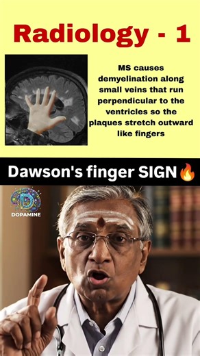 Dawson’s Fingers| Best app for NEET PG Preparation |Dopamine|