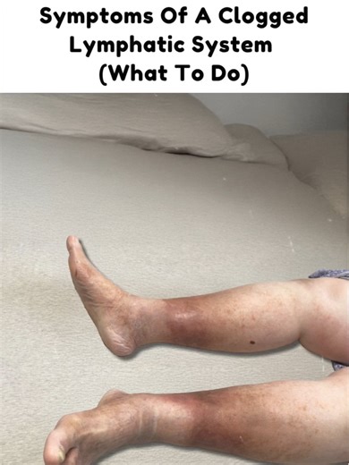 Struggling with swollen legs, puffy feet, or constant fatigue? Lymph System Support is a powerful, doctor-approved lymphatic support supplement designed to stimulate lymph flow, flush toxins, and reduce swelling for a cleaner, lighter, more energized you.