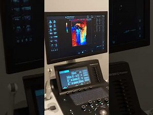 2 in 1: MicroTESE and Varicocelectomy