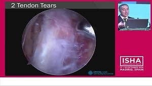 Endoscopic Hamstring Repair - Proximal Hamstring Tears