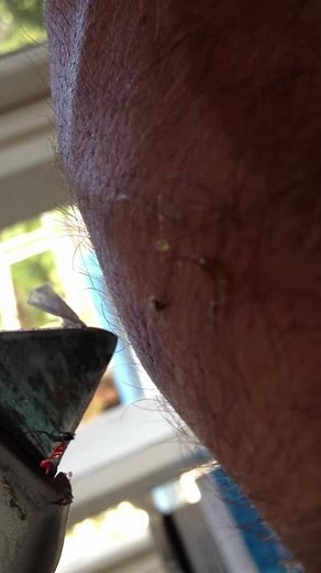 How to remove a bee sting