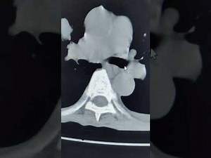 **Lesson in Thai** CT Pulmonary Angio, CT GE software. smartprep. positioning.