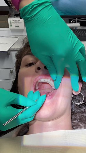 Heres the reveal we have all been waiting for!! These will be my temps for the next 4-6 months♥️🙏🏻 #dentalimplants #temp #healingjourney #day7 #implantjourney #reveal #update