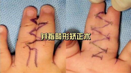 并指畸形矫正术（非医学相关专业慎入）