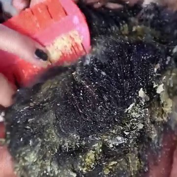 BIG DANDRUFF FLAKES Scalp scratching and picking Satisfying Dandruff Removal # 218