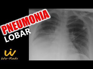 Pneumonia Lobar no Raio-X e na Tomografia Computadorizada de Tórax