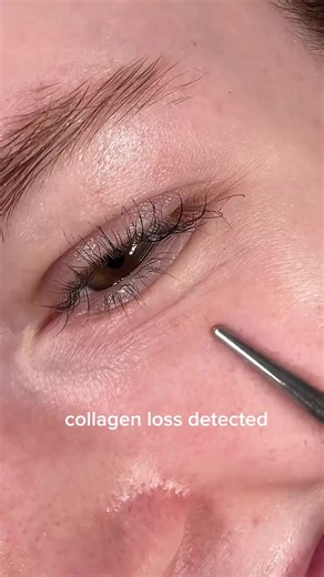 Abib Eye Patch باتشات العين من ابيب Abib عناية فورية لمنطقة تحت العين 🌿 ترطيب عميق، إشراقة واضحة، ومظهر أكثر نعومة من أول استخدام. مثالية للتعب، الانتفاخ والخطوط الدقيقة لتمنحك عيون منتعشة ومشدودة. التركيبة كولاجين مستخلصات نباتية مهدئة حمض الهيالورونيك النياسيناميد أدينوسين الفوائد ترطيب مكثف لمنطقة تحت العين تقليل مظهر الخطوط الدقيقة تحسين مرونة الجلد تهدئة الانتفاخ والإرهاق منح إشراقة ونضارة فورية السعر ٣٥ #abib #abibeyepatch #eye_patch #undereye_care #hydrating brightening skincare kbeauty