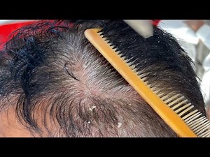 How to get rid dandruff flakes scratching with comb 🪮🥵scratching dandruff off scalp