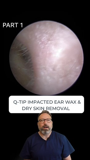 Effective Q-Tip Impacted Ear Wax & Dry Skin Removal Techniques