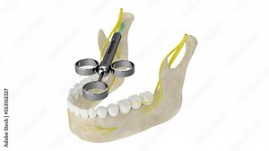 Mandibular arch with gow-gates nerve block. Types of dental anesthesia concept.