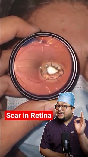 Inside Your Eye | Indirect Ophthalmoscopy Explained