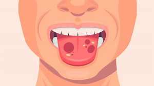 Have You Ever Dealt With Swollen Taste Buds? Know It Causes And How To Cure It