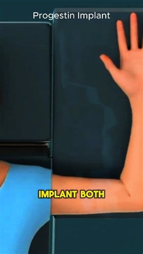 16K views · 125 reactions | #iud #implants #birthcontrol #flexible #hormones #uterus #effective #both #medical3danimation #3dmedicalanimation | Medcare777 | Facebook