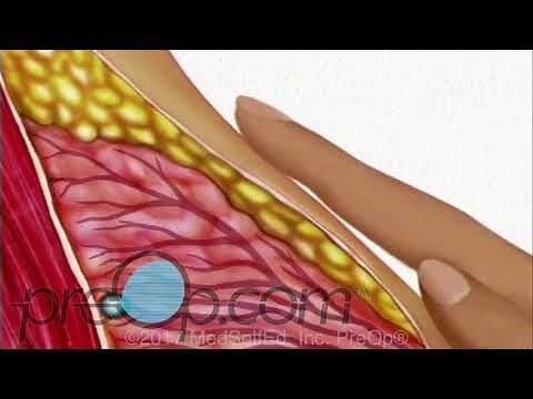 Breast Needle Biopsy Procedure • Patient Education Surgery