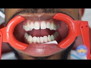 Mastering Invisalign Attachments: Step-by-Step Placement Guide