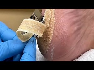 EXTREME FOOT PEELING TRANSFORMATION | Massive Dead Skin & Callus Removal (4K)
