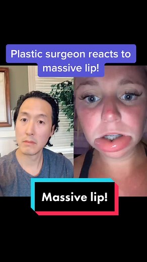 Plastic Surgeon Reacts to Massive Lip | Allergic Reaction Alert!