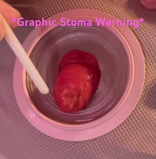 *Graphic* ileostomy warning! Live loop ileostomy | My ileostomy journey💕🌸
