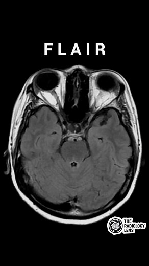 18K views · 158 reactions | Diagnosis⬇️ #NeuroImaging #BrainMRI #CTBrain #MRIImaging #NeuroRadiology | The Radiology Lens | Facebook