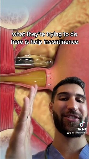 This Procedure Fixes Incontinence After Prostate Surgery