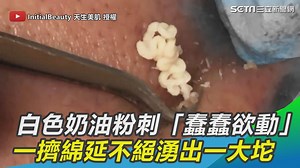 13K views · 172 reactions | 這粉刺好多啊！源源不絕狂冒出來～～（ 小草西） ▌白色奶油粉刺「蠢蠢欲動」...