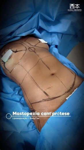 Mastopexia com prótese + lipoaspiração + BodyTite: Um resultado incrível!✨