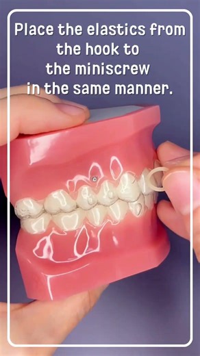 How to wear rubber bands with your Invisalign