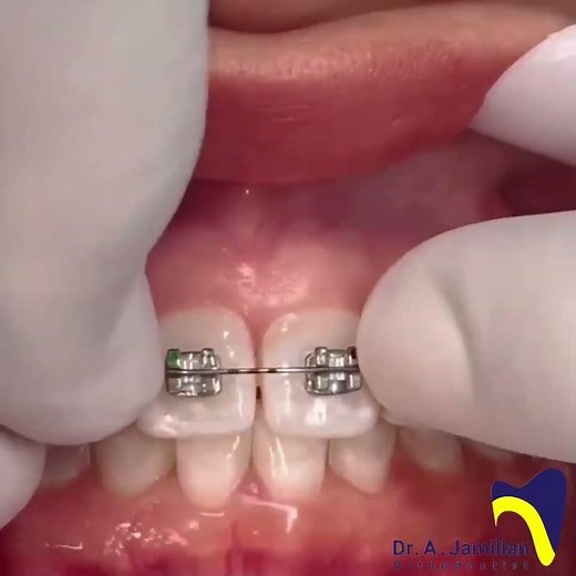 Orthodontic Bonding Procedure | Brackets Placement #dentist #bonding #braces #orthodontics #bracket