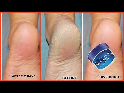HOW TO GET SOFT FEET OVERNIGHT, Get rid of rough cracked heels