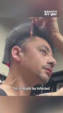 Draining my own cyst #shortsfeed #cyst #shorts #draining # head #needle