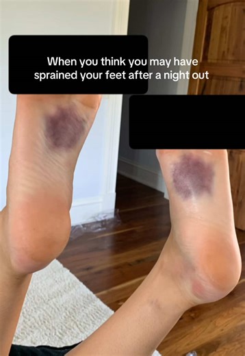 I don’t miss being 21 and insane let’s just say that #injury #fail (I saw someone else do this trend & had to hop on)