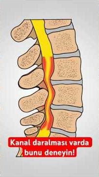 If you have spinal stenosis, try this! #physiotherapist