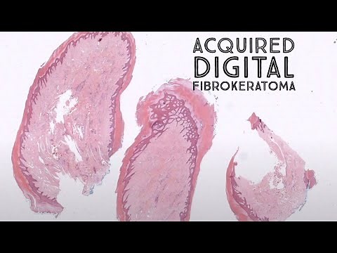 Acquired digital fibrokeratoma - skin papule on hand or foot (‪pathology dermpath dermatology)