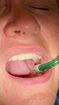 How Dentists Hide Screw Access Holes on Implant Crowns #dentalimplants