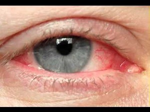Eye cancer symptoms