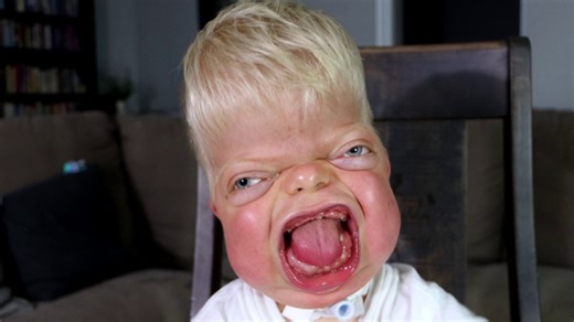 Michael is one of just five people in the world diagnosed with Bent Bone Dysplasia. At birth, doctors believed he wouldn’t survive more than a few days. Today, at 4 years old, he’s full of life and joy. Michael and his family want others to know that while he may look different, he deserves to be treated just like any other child. | Special Books by Special Kids