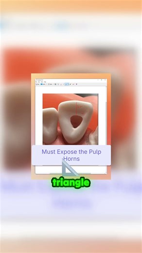 Are you making these common mistakes in anterior endo access?