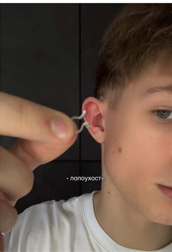 Лопоухость и методы исправления: отопластика